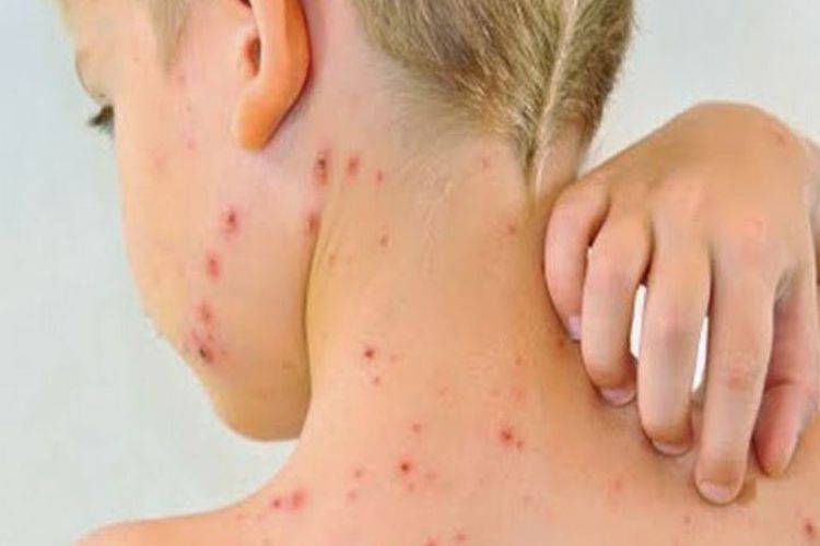 Dinas Kesehatan (Dinkes) DKI Jakarta menyampaikan saat ini ada 10 kasus positif cacar monyet atau monkerpox 10 kasus positif itu tertular dari kontak seksual