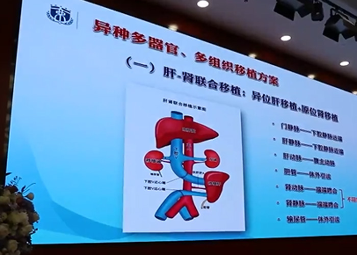 Operasi xenotransplantasi ini dilakukan oleh para peneliti dan dokter di Rumah Sakit Xijing yang berafiliasi dengan Universitas Kedokteran Angkatan Udara di Xi'an