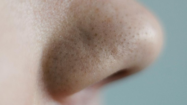 Komedo yang muncul di wajah bisa bikin kepercayaan diri menurun Kamu dapat mengatasinya dengan mencoba cara membersihkan komedo pakai bahan-bahan alami