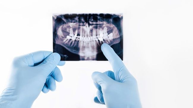 Kanker mulut jadi salah satu penyakit yang perlu diwaspadai Anda perlu mewaspadai minuman penyebab kanker mulut di bawah ini