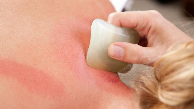 Kerokan dianggap sebagai budaya pengobatan tradisional yang dilakukan secara turun temurun di tengah masyarakat Indonesia Metode ini diyakini bisa mengatasi berbagai masalah kesehatan yang ringan