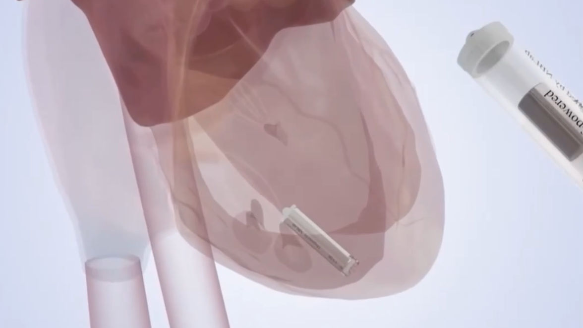 Peneliti Tiongkok Mengembangkan Alat Pacu Jantung Mandiri Seukuran Kapsul