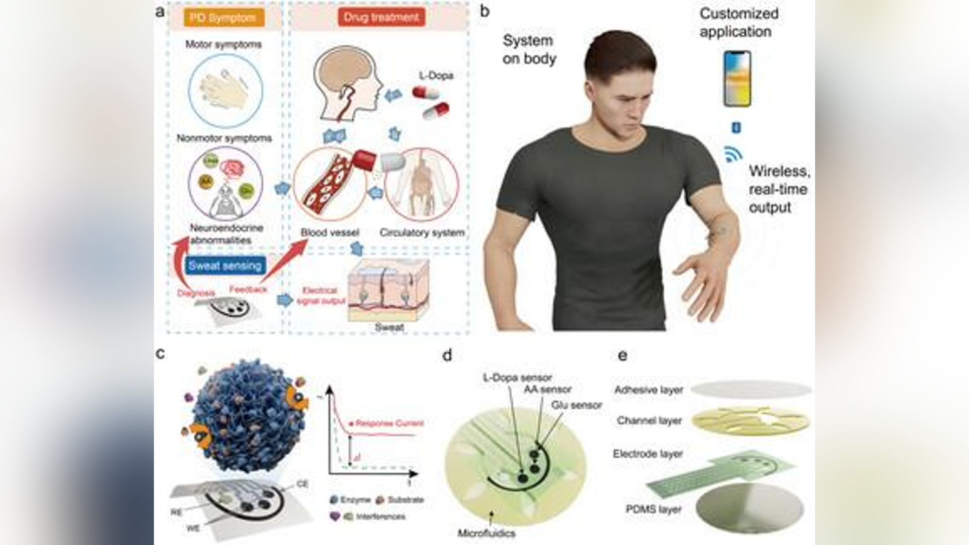 Penyakit Parkinson adalah kelainan neurodegeneratif progresif yang sulit ditemukan pada tahap awal